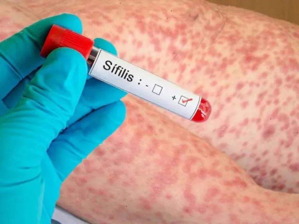 sifilis-1024x768